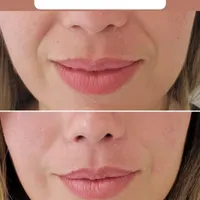 تزریق ژل لب بوتاکس مزوتراپی فیلر صورت در تهران|خدمات آرایشگری و زیبایی|تهران, میدان انقلاب|دیوار
