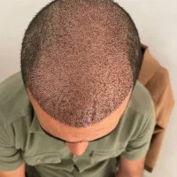 کاشت مو و ابرو میکروگرفت