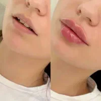 بوتاکس ۴۹۹ هزار تومان (مصپورت)