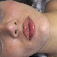 ژل بوتاکس از650تومن ،آموزش ژل و بوتاکس مزو۱۰تومن