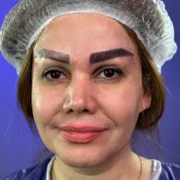 کاشت ابرو میکروسکوپی