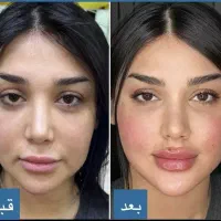 رفع تیرگی و لک،هایفو و لیفت و تزریق فیلر