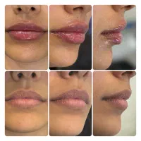 جوانسازی و بوتاکس / توسط پزشک / شاهین ویلا