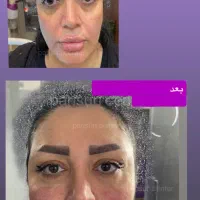 تخفیفات ۷۰درصدی تزریقات فول فیس،لب و بوتاکس