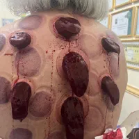 حجامت تخصصی و درمانی و ویژه