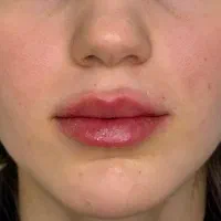 تخفیف بهاره خدمات زیبایی در کلینیک نویا فومن