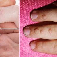 رفع منگوله های گوشتی