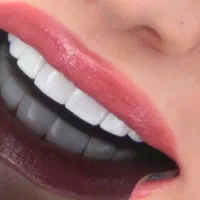 کامپوزیت. لمینیت. خدمات درمان و ایمپلنت و متحرک