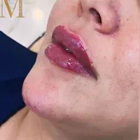 تزریق و آموزش تخصصی فیلر و بوتاکس و پرسینگ و غیره