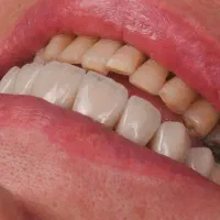 تخفیف ویژه لمینت و کامپوزیت دندان  ظرفیت محدود