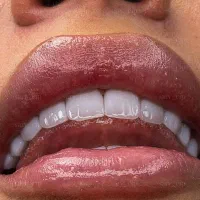 طرح تعویض کامپوزیت قدیمی با کامپوزیت جدید