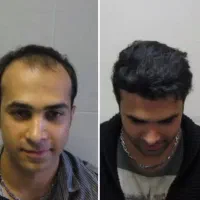 نظرت چیه باکاشت مو ۱۰سال جوونتربشی با جدیدترین روش