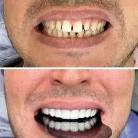 تخفیف کامپوزیت به مدت یک هفته
