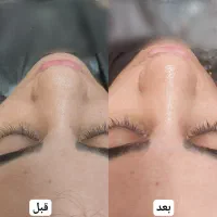 تخفیف آخر ماه فیشیال تکنیک پوست کره ای