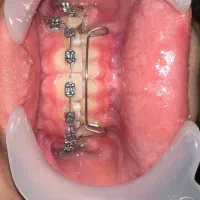 ارتودنسی، ایمپلنت و کامپوزیت اقساط + مشاوره رایگان