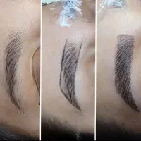 میکرو کاملا تارمویی ریمو تک جلسه ای درمشهد