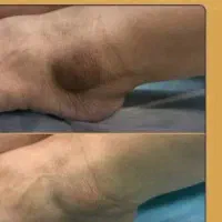 روشنی وجوانسازی کلینیکال بکینی-آرنج -قوزک پا-زانو