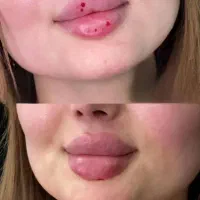 تزریقات ژل و بوتاکس و آموزش صفر تاصدحرفه ای