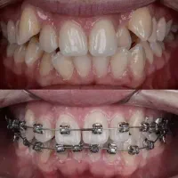 ارتودنسی توسط متخصص*اقساط بدون چک و کارمزد*