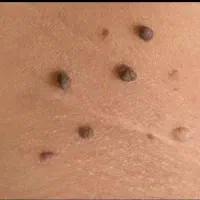 hpv/hsv