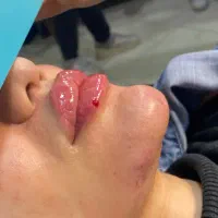 فیلر|خدمات آرایشگری و زیبایی|مشهد, خواجه ربیع|دیوار