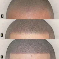 اسکالپ مو(پوشش نواحی کم پشت و خالی )