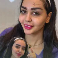 کاشت ابرو باجراحی و بدون جراحی