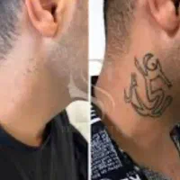 حذف تتو در مطب با دستگاه کیوسوییچ امریکایی