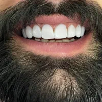 دندان مصنوعی ، روکش دندان ، کامپوزیت