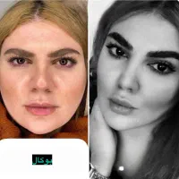 بلفاروپلاستی ،سانترال لب،بوکال فت،غبغب
