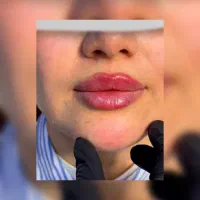 زیبایی نیلگون تخفیف میکروبلیدینگ،فیبروز،فیلر(ژل)