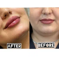فیلر لب با کیفیت بالا حجم طبیعی و فرم دهی دلخواه