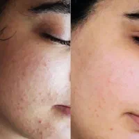 پاکسازی وفشیال پوست