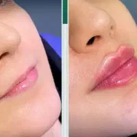 مدل فیلر لب  برای عکاسی و فیلمبرداری پیج