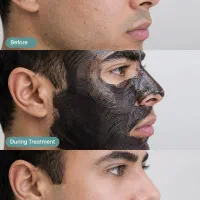 کربن تراپی روشن سازی صورت و نواحی تیره(گلبرگ)