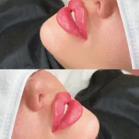 فیلر و بوتاکس فقط ۸۵۰ توسط پزشک فقط تا یکماه