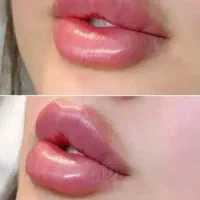 ژل۸۰۰بوتاکس فقط۸۰۰ فول فیس فقط وفقط۶۹۰۰
