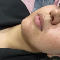 تزریق ژل و بوتاکس