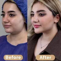 تخلیه غبغب و زاویه سازی(ساکشن غبغب)