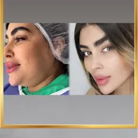 ساکشن غبغب نقد واقساط بوکال فت بلفارو کاشت ابرو|خدمات آرایشگری و زیبایی|تهران, پونک|دیوار