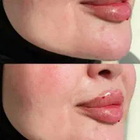 ژل،فیلر ،بوتاکس،مزوژل،کانتور صورت