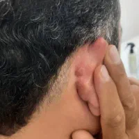 لیزر،درمان انواع زگیل تناسلی،خال،میخچه،لک پوستی