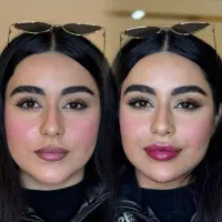 جشنواره ژل و بوتاکس با قیمت باورنکردنی/اقساط