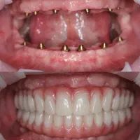 دندانپزشکی اوردنچر دو فک vip(اقساطی)