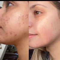 رفع جوش و جای جوش و لک و منافذ