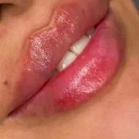 جشنواره تابستانه بوتاکس و تزریق فیلر