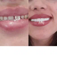 کامپوزیت دندان زیبا با کمترین قیمت