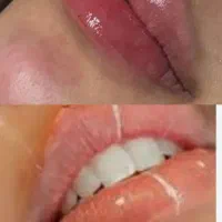 ژل و بوتاکس خانم و آقایان