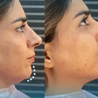 جشنواره تززیق فیلر چانه و خط خنده گوهردشت