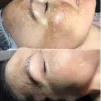فیشال (پاکسازی ) تخصصی پوست بانوان